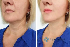 Double chin before and after Hi-Fu treatment 4 Book your double chin treatment Tyne and Wear today! We are here to help!