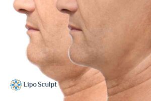 Double chin before and after Hi-Fu treatment 2 Double chin treatment Tyne and Wear from Lipo Sculpt - feel more confident today!