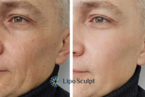 How to Fight Aging Symptoms 3 Fight Aging Symptoms Tyne and Wear With HIFU and Morpheus8 Today!