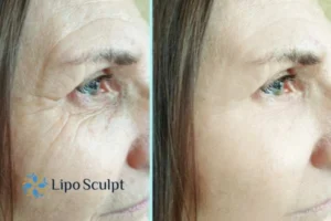 How to Fight Aging Symptoms 2 Do you want to Fight Aging Symptoms Tyne and Wear? Contact Lipo Sculpt today!
