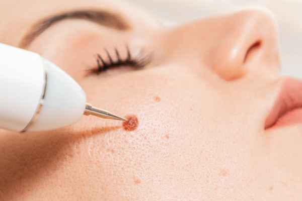 CryoPen: 5 Skin Concerns It May Be Used to Treat 3 What actually happens during a CryoPen treatment Tyne and Wear?
