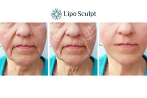 Explaining Morpheus8 And What It Can Do For You 3 Boost your confidence with Morpheus8 Tyne and Wear call our team today!