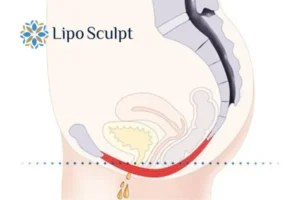 Pelvic Floor Chair Therapy 1 Pelvic Floor Chair Therapy Tyne and Wear to treat incontinence.