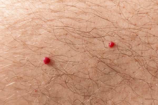 CryoPen: 5 Skin Concerns It May Be Used to Treat 2 cherry angioma removal Tyne and Wear