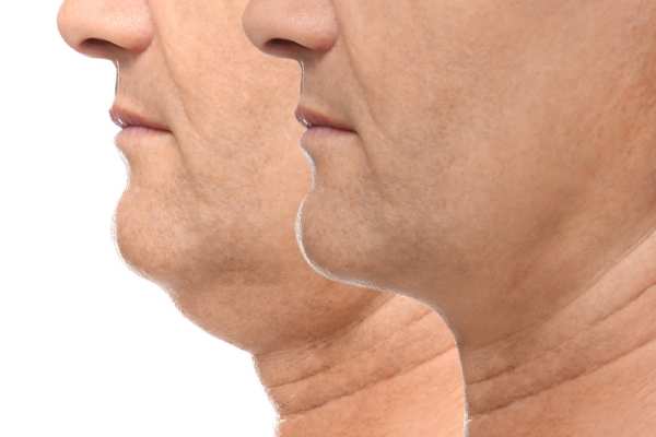 Book your Chin Reduction Treatment Tyne and Wear today!
