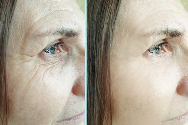 Why Do People Choose HIFU for a Non-Surgical Facelift? 4 How long can HIFU results last Tyne and Wear?
