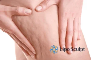 CoolSculpting for Legs: The Innovative Approach to Redefining Your Legs 5 Start your journey today book your coolsculpting treatment Tyne and Wear online today!