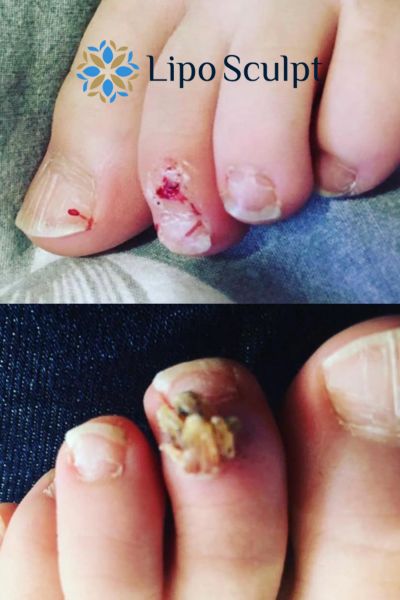 Wart removal customer results from Lipo Sculpt Tyne and Wear