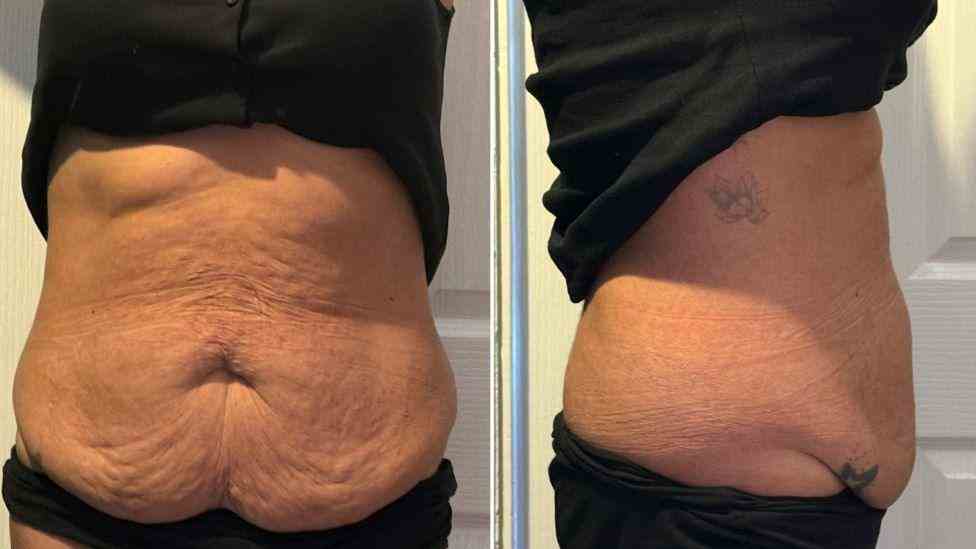 Lost the Weight but Not the Loose Skin? What You Should Know 1 Is It Definitely Loose Skin Tyne and Wear?