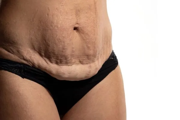 Lost the Weight but Not the Loose Skin? 1 image of womans stomach after weight loss showing loose skin Tyne and Wear
